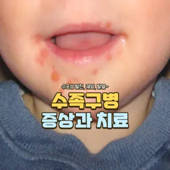 수족구 초기 증상 어른 감염 격리기간 예방 치료 완전 가이드_21