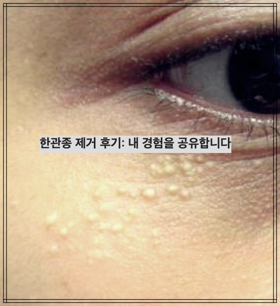 한관종 제거 후기: 내 경험을 공유합니다