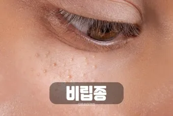 얼굴 비립종 없애는 법 자극 없이 제거하는 피부관리법_6