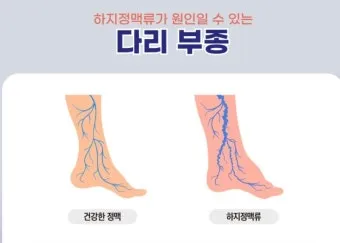 부종의 원인과 증상 5가지 개선방법 치료법_9