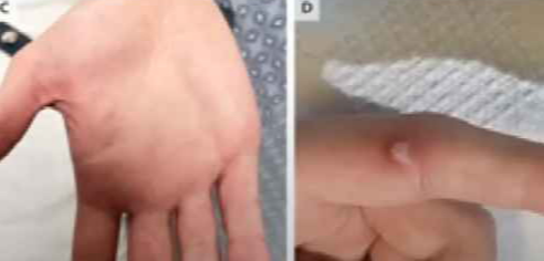 원숭이두창 증상