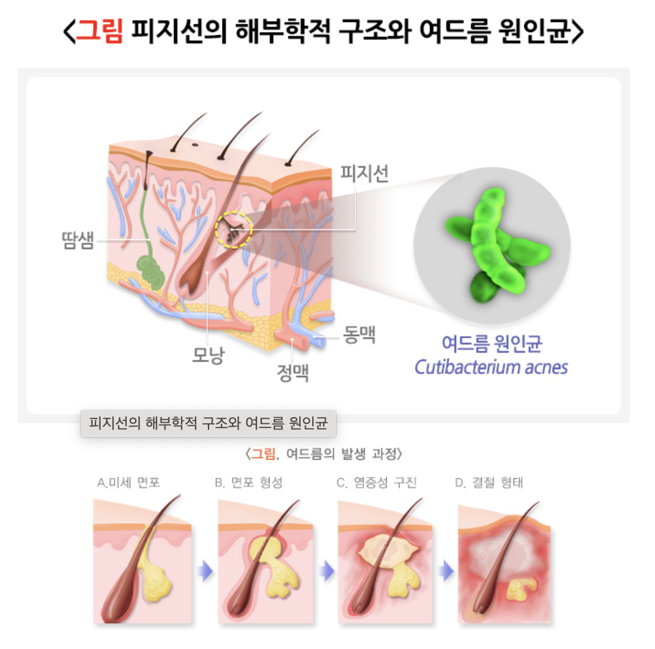 여드름 원인균