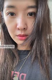 눈밑지방재배치