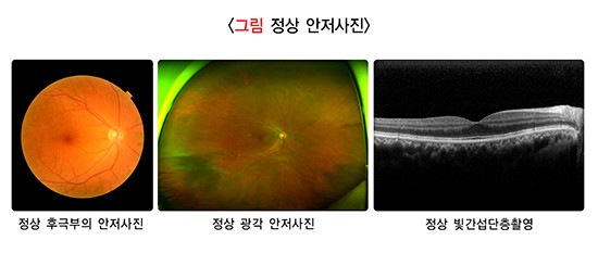 당뇨망막병증