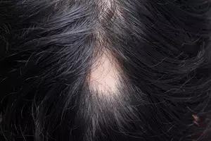 원형탈모