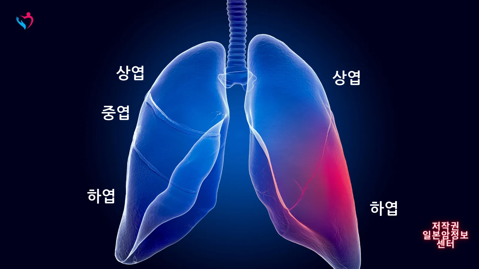 폐암 증상 원인 검사 치료