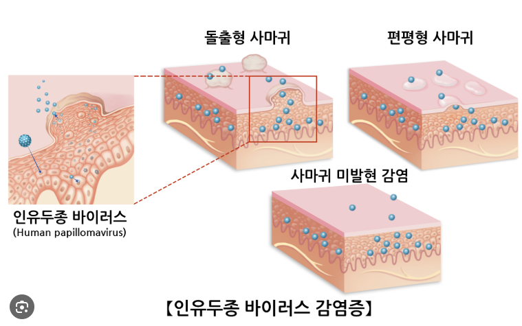HPV 바이러스 사마귀
출처 : 서울 아산병원