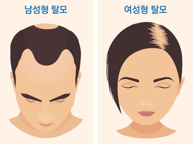 탈모약-판시딜