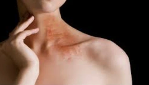 대상포진