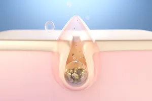 블랙-헤드-제거-방법