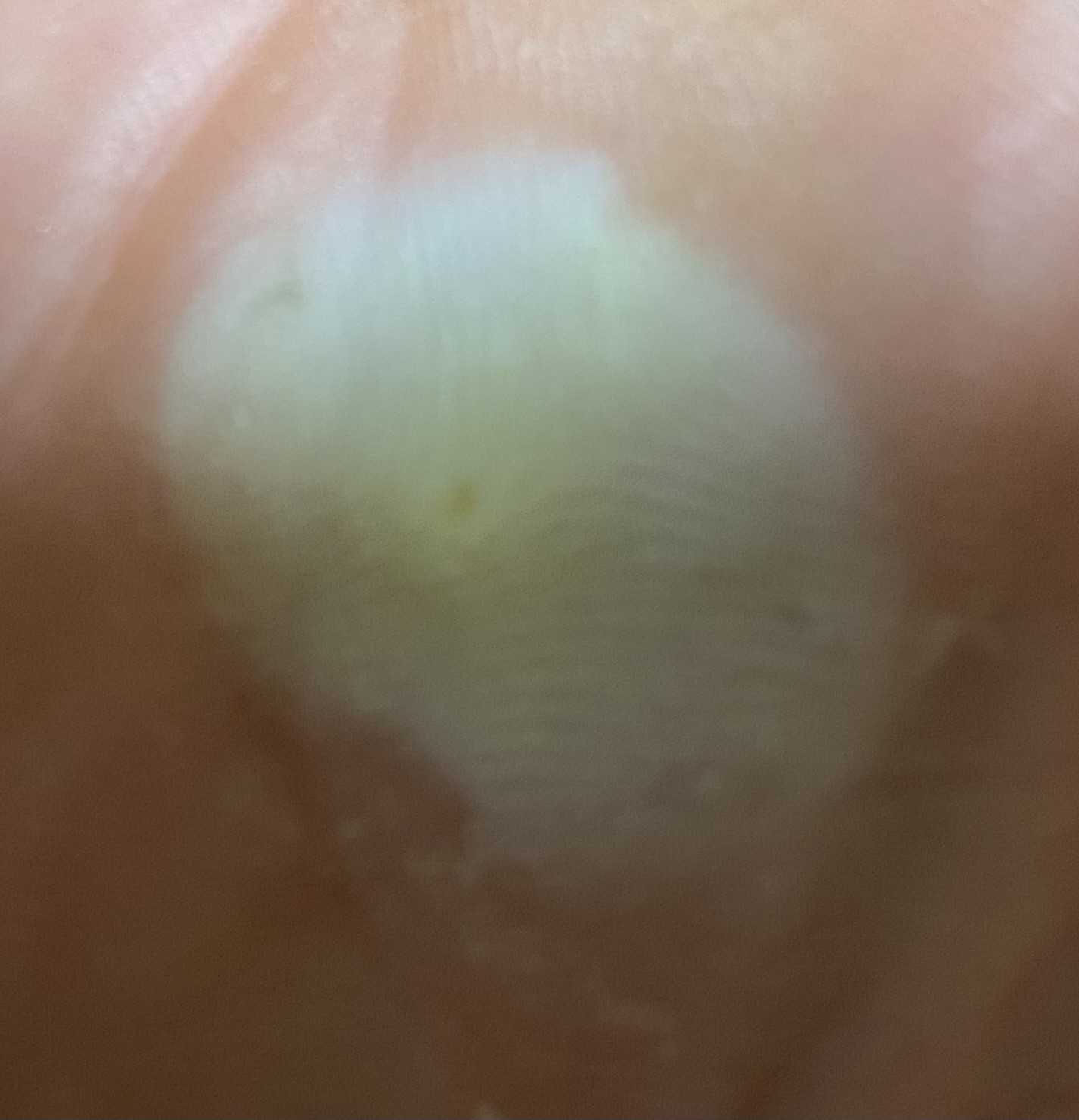 둘째날 아침 이때 박혀있던 모래를 뺄 수 있었어요.