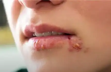 입 주변 단순 포진