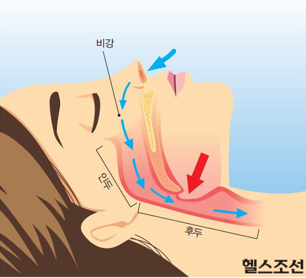 코골이의 원인인 비강부터 후두까지의 공기 길이 좁아져서 생긴다.