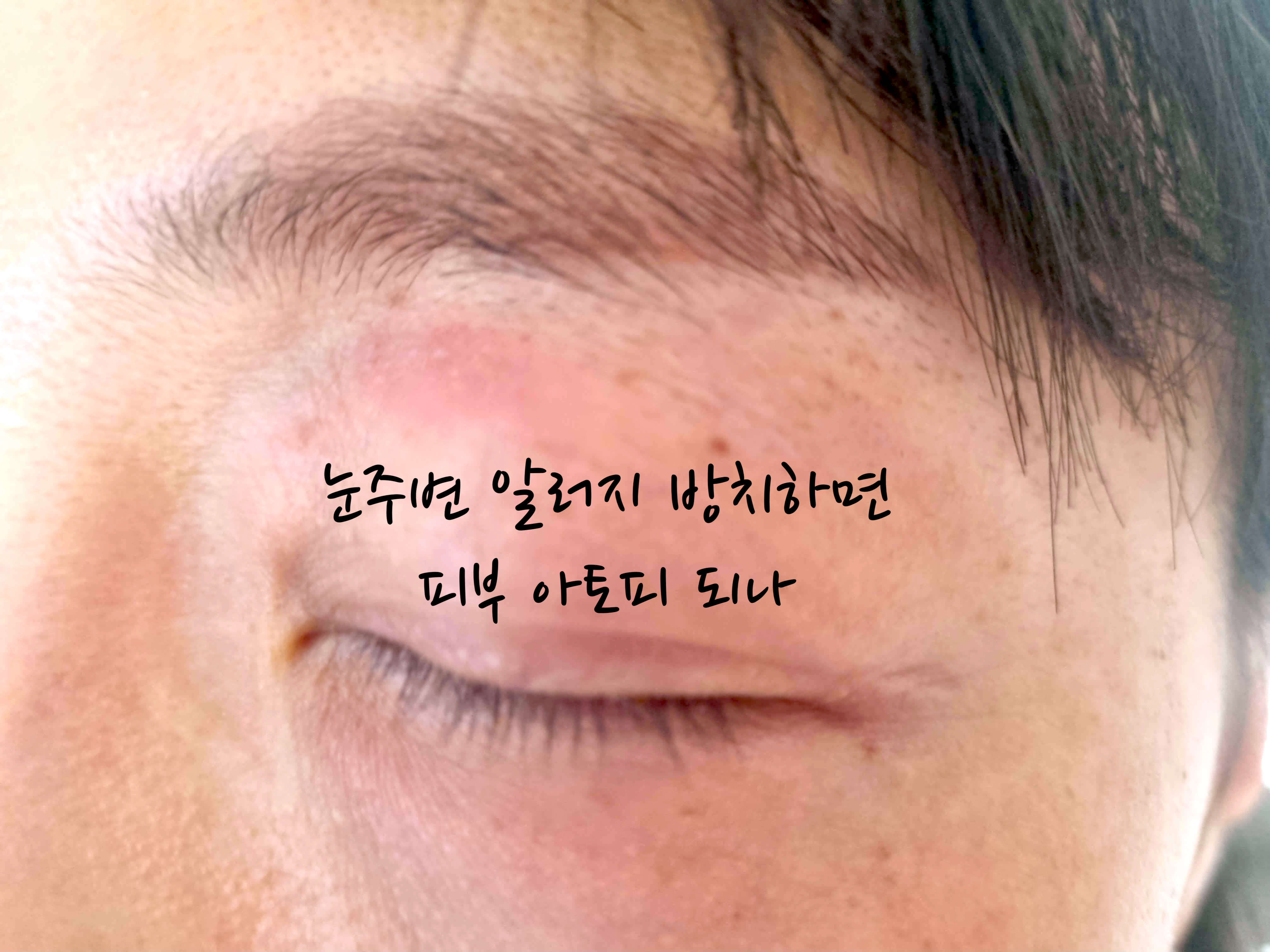 눈주변 알러지