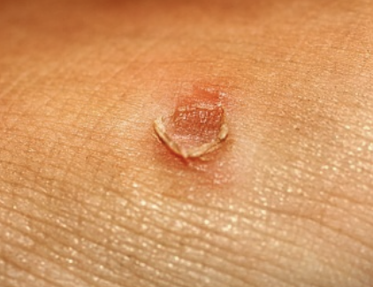 티눈 없애는 방법 10가지 총정리 섬네일