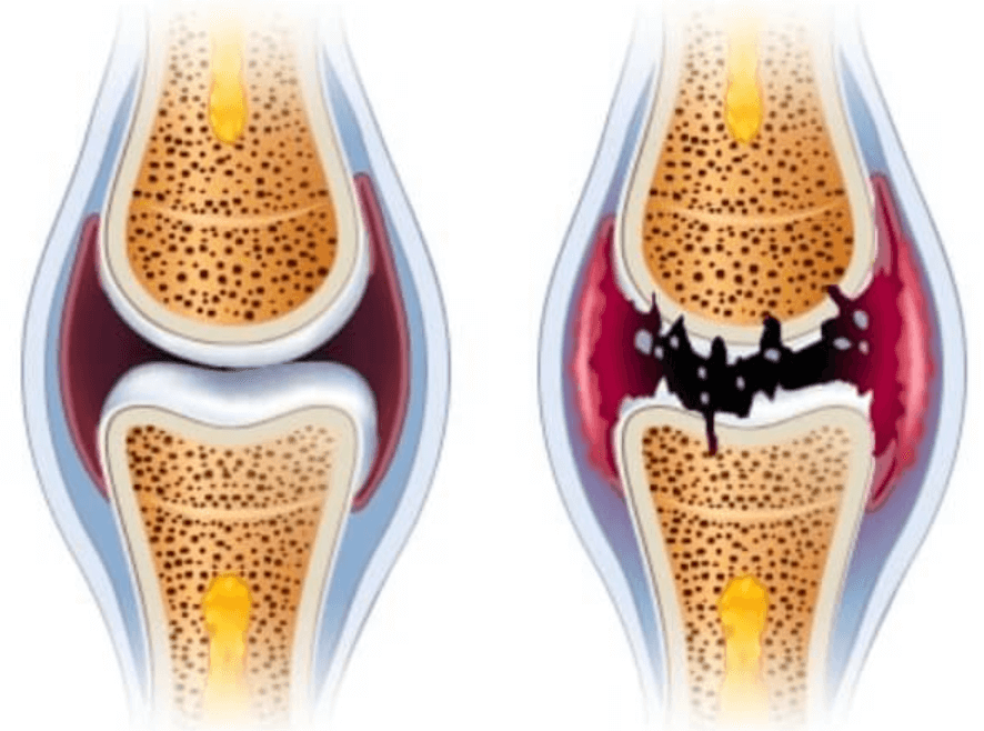 콘드로이친-효능-복용법