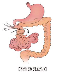 장폐색이란