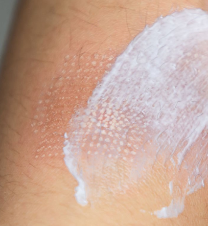 화상 물집 치료 연고 효과 응급처치법 화상 흉터 제거