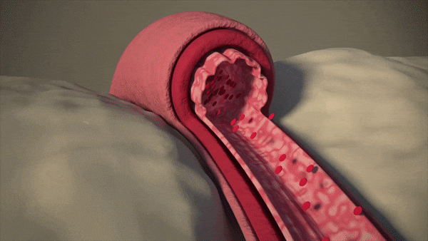 LDL 콜레스테롤의 좋지 않은 영향