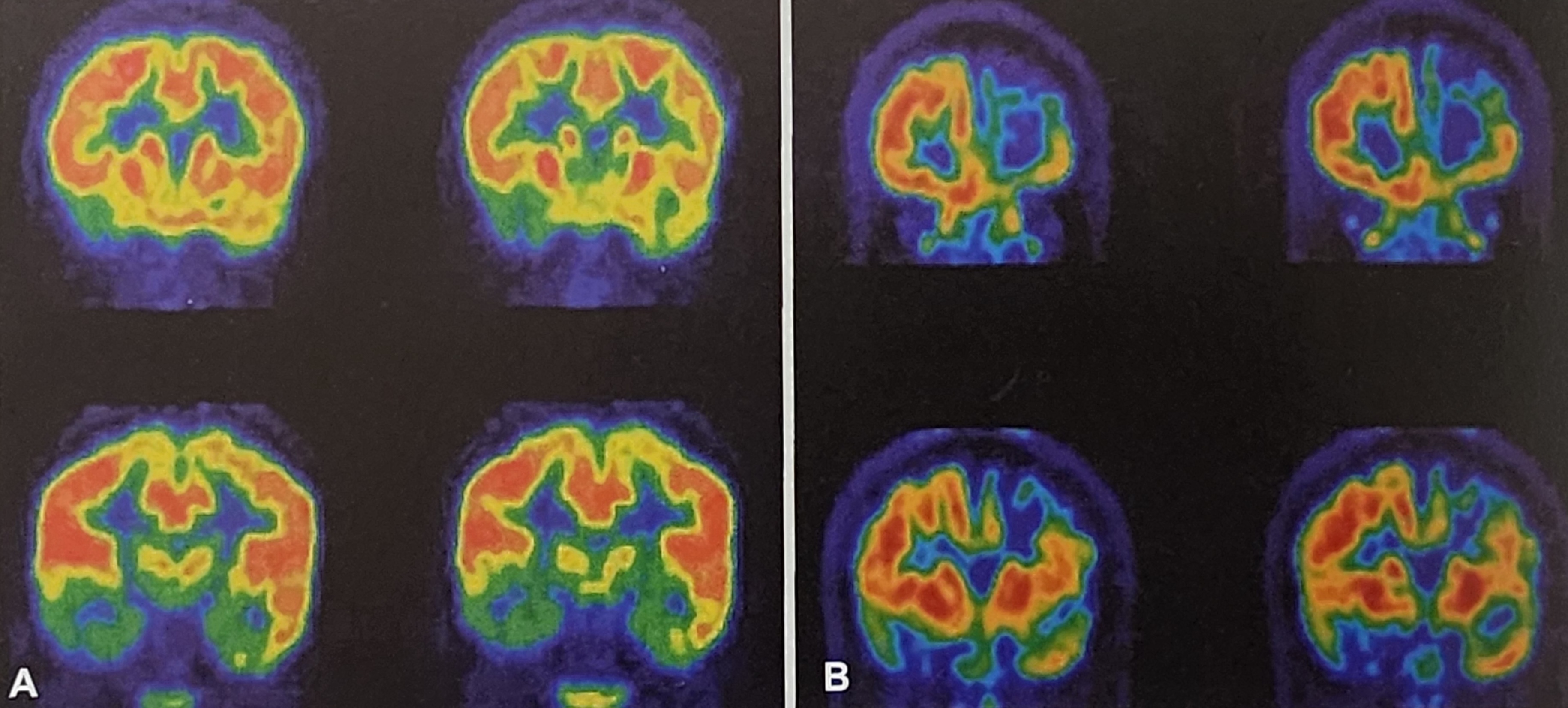 뇌전증 수술 전 검사