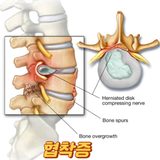 협착증