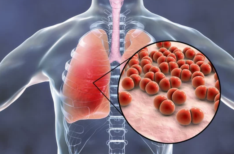 한국MSD 성인 21가 폐렴구균 백신 허가