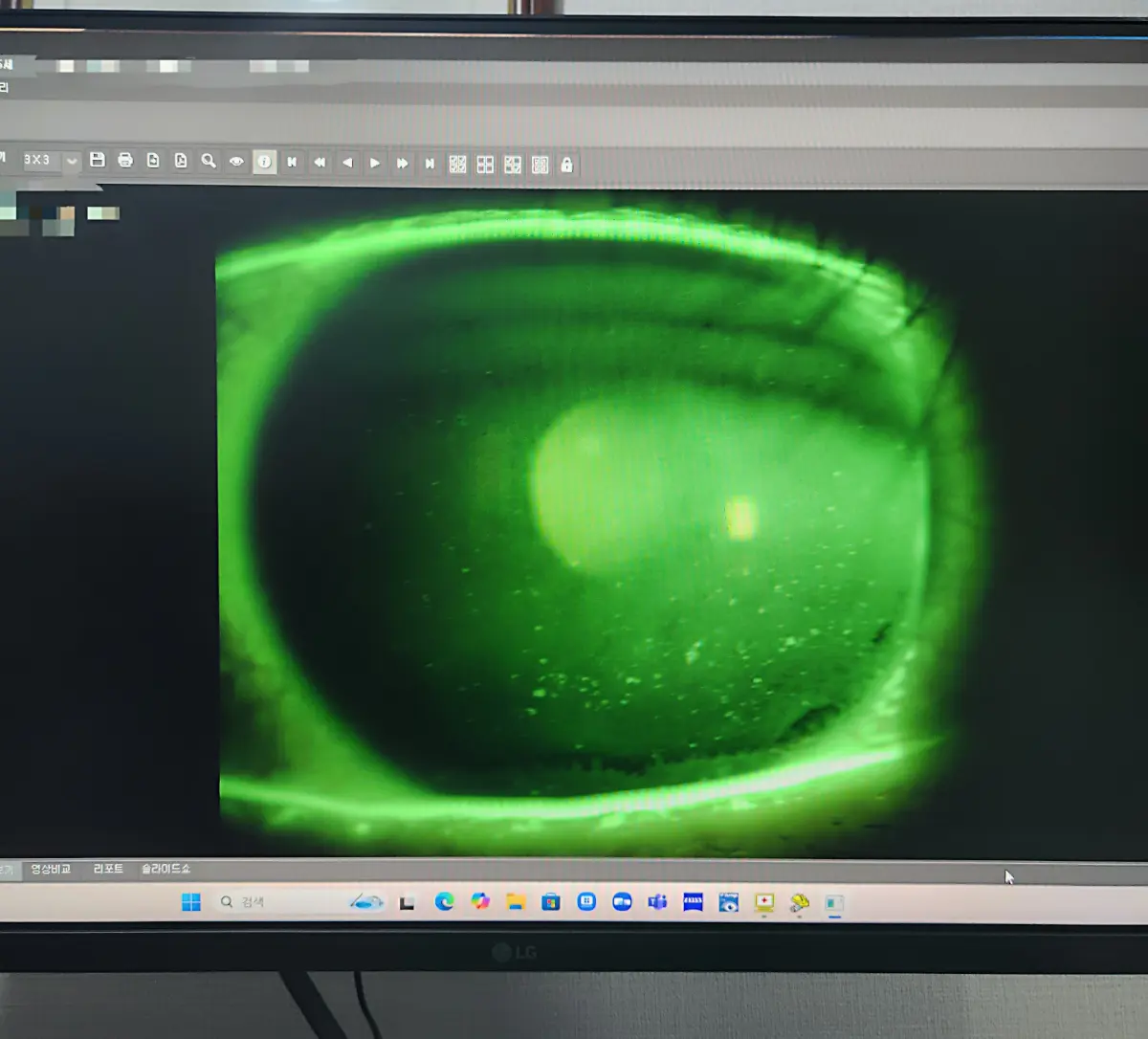 안구건조증-방치-각막-상처들-각막미란