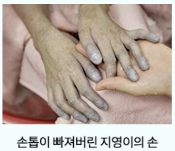 손톱이 다 빠진 지영이