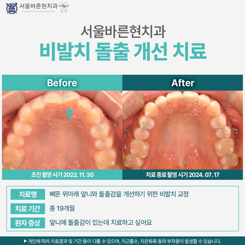 부산치아교정