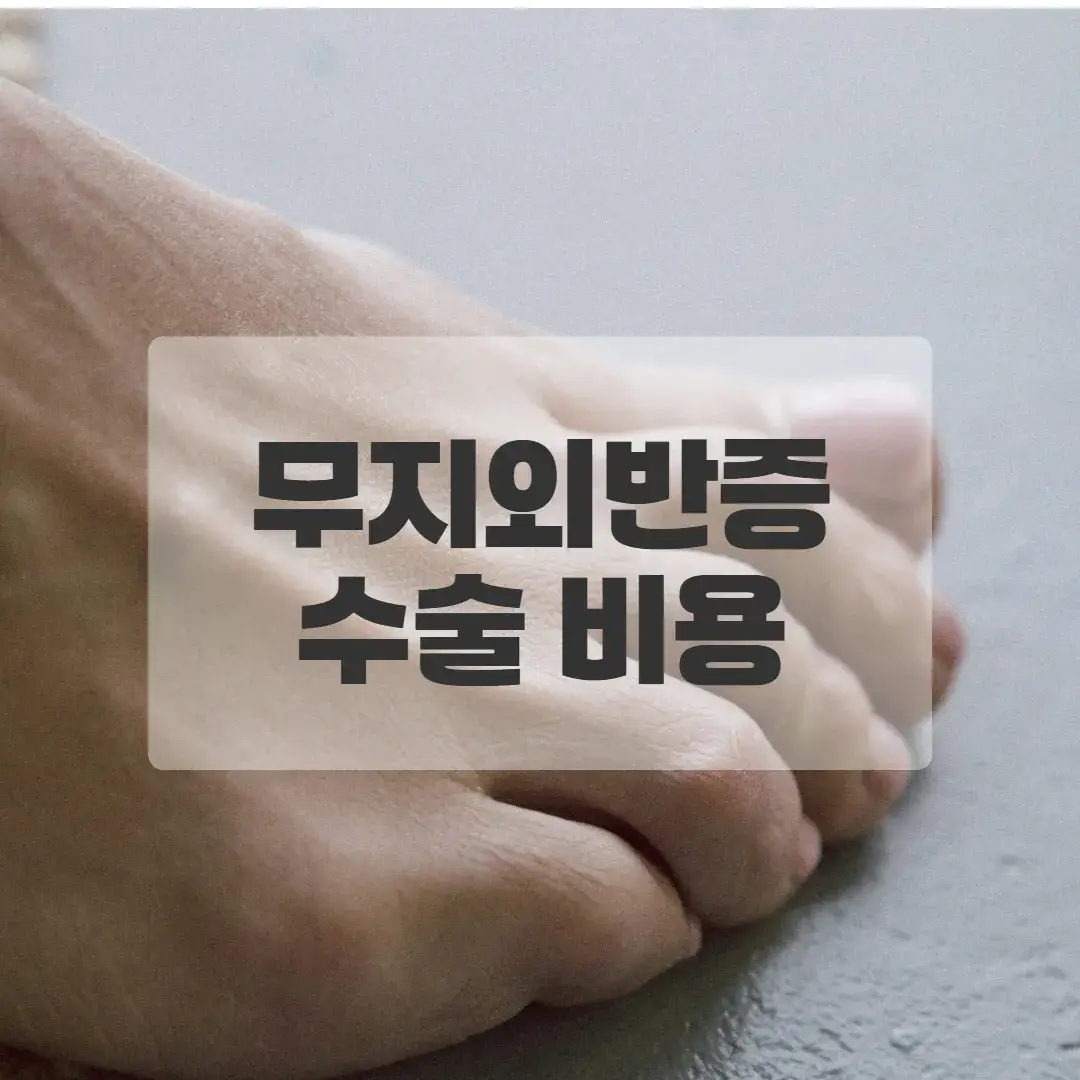 무지외반증 수술비용