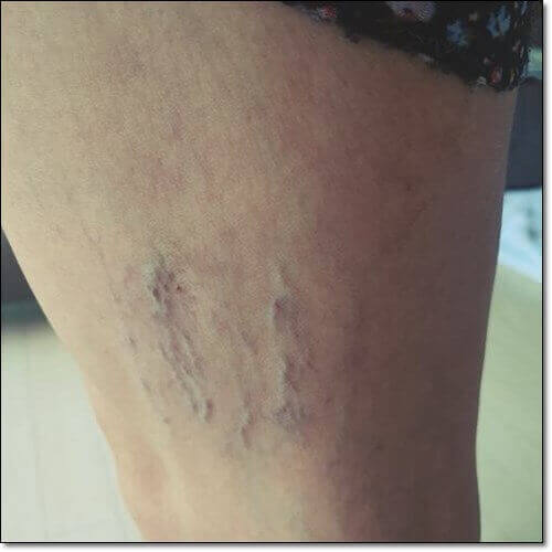 하지정맥류 사진