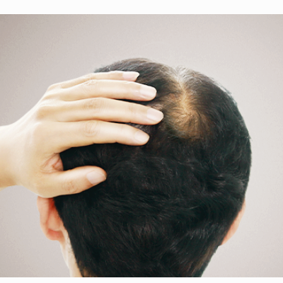 탈모 관련주 대장주 테마주 수혜주 TOP5