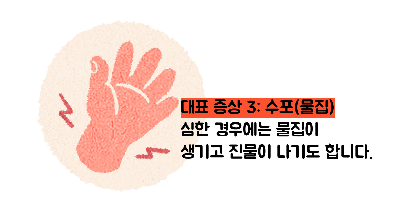 햇빛 알레르기 증상