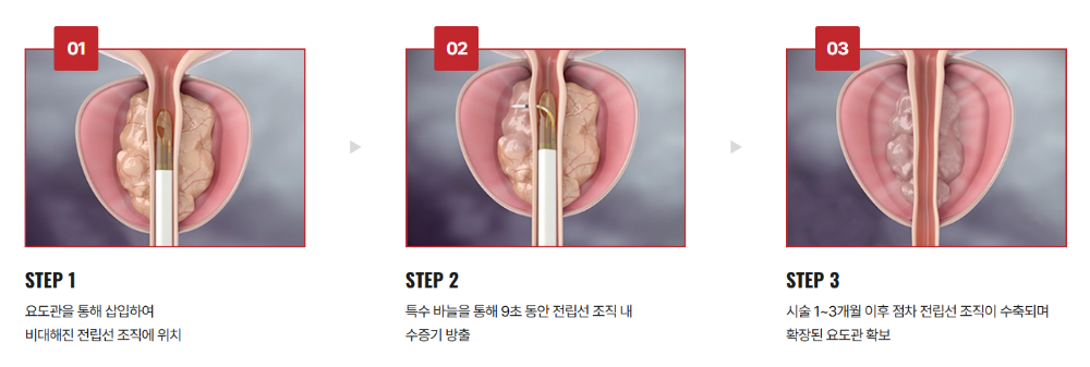 리줌 시술 방법 및 원리 출처 칸비뇨의학과