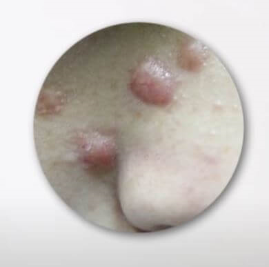 비후성 흉터 예시