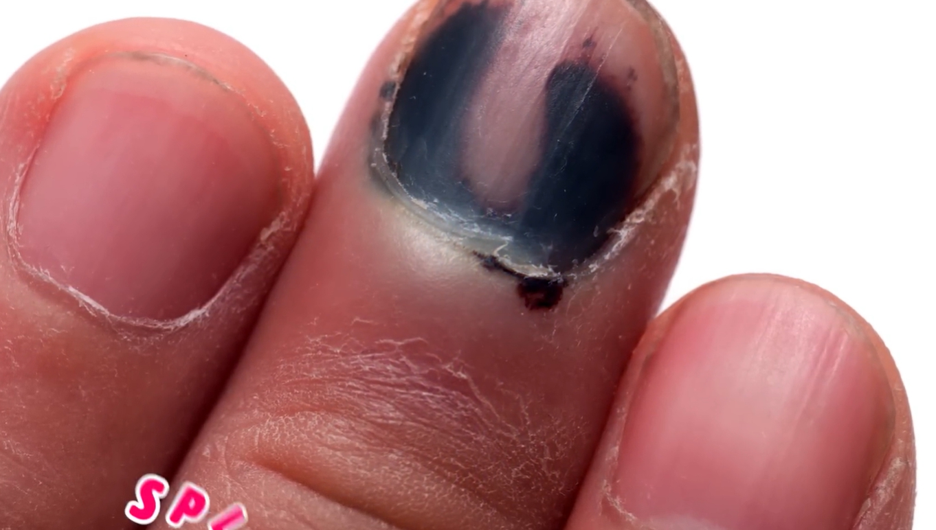 발톱이 검게 변하는 이유