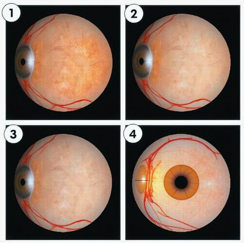 녹내장의 진행에 따른 시야 변화를 보여주는 4단계 이미지. 1단계는 정상 시야, 2단계는 주변부 시야가 약간 좁아진 모습, 3단계는 시야가 더욱 좁아진 모습, 4단계는 터널 시야처럼 중심부만 남은 모습을 보여줍니다.