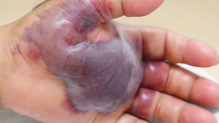 비브리오 패혈증 증상 18가지 및 비브리오 패혈증 예방법 잠복기 치사율 총정리