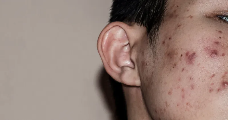 여드름 자국