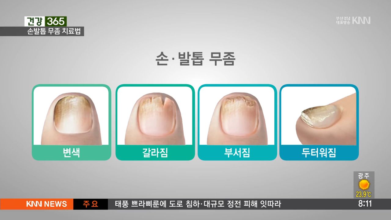 2026 발톱무좀 완치 루틴 공개｜약보다 중요한 4단계 관리법