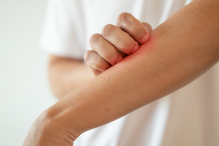 아토피 atopic dermatitis
