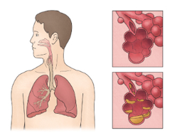폐렴의 x-ray 사진
