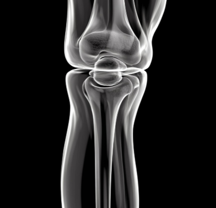 무릎 물찼을 때3