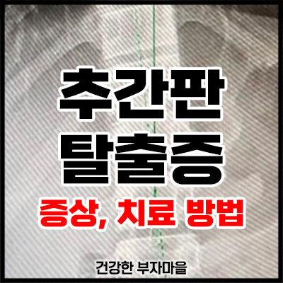 추간판 탈출증