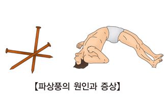 파상풍증상