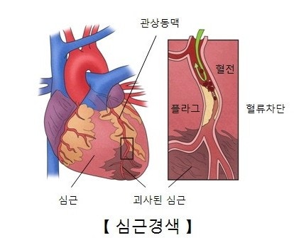 심근경색 전조증상 체크리스트 – 놓치면 생명 위협됩니다 관련 사진