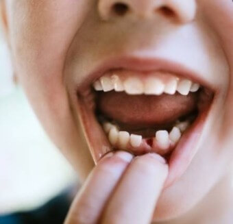 가운데-아랫이빨이-빠져-입술을-젖히는-어린이