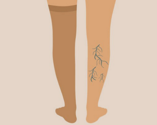하지정맥류