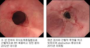 역류성 식도염 초기증상&amp;#44; 가볍게 넘기면 관리가 어려워지는 이유