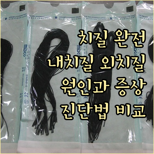 내치질 외치질 완전 분석! 증상, 원..